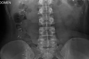 Understanding Sitz Marker Study Abnormal Results: Causes &amp; Solutions | Study Travel Abroad | Explore Educational Trips & Global Learning Opportunities