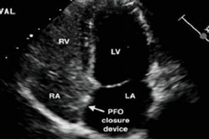 What is a Bubble Study Echocardiogram? Uses & Info | Study Travel Abroad | Explore Educational Trips & Global Learning Opportunities
